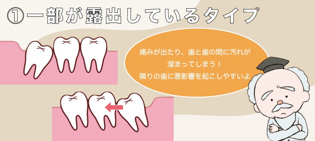 親知らず　一部露出している