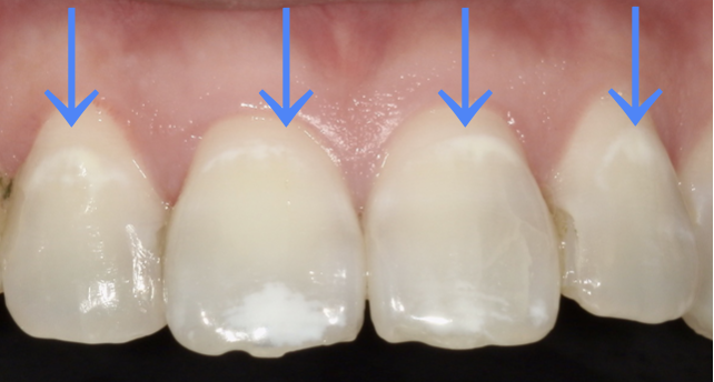 歯の白い斑点  削らずに治せる方法って？