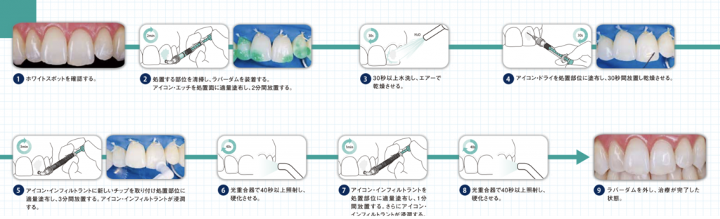 アイコン治療の流れ